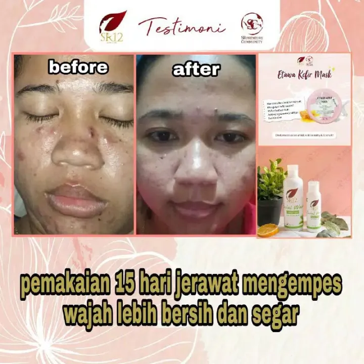 Terlaris Paket Kulit Minyak Berjerawat Sr12 Penghilang Minyak Wajah Penghilang Jerawat Obat Jerawat Minyak Berlebih Muka Berminyak Muka Berjerawat Lazada Indonesia