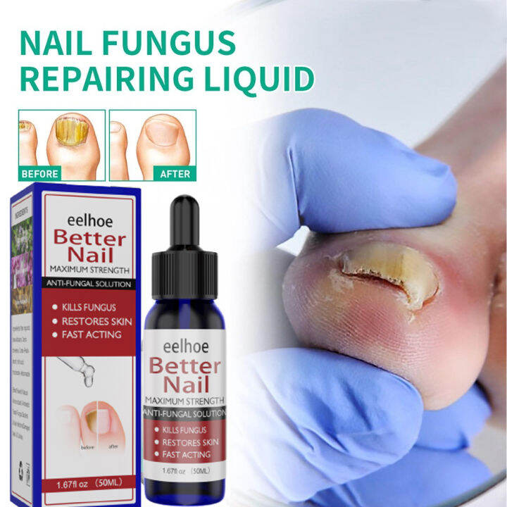 100 Effective Nail Fungus Treatment Serum nail fungus repair treatment Cream 50ml Fungisol