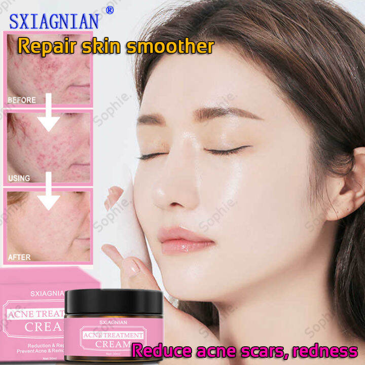 (Quick results)SXIAGNIAN Acne Cream a good helper to fight acne and