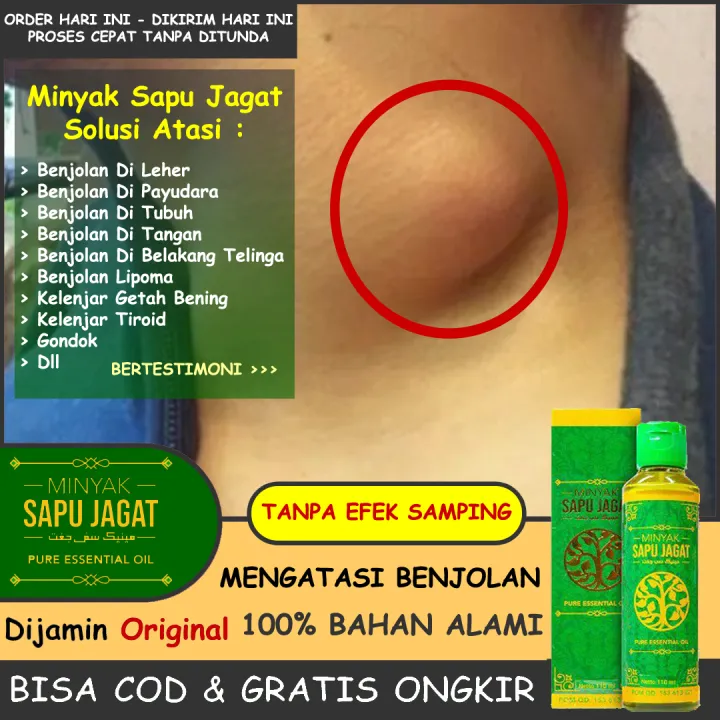 Oilife Oles Obat Benjolan Di Leher Payudara Tubuh Tangan Belakang Telinga Penghilang Lipoma Lunak Keras Minyak