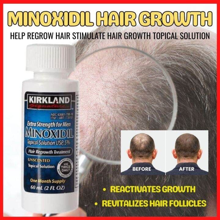 TRENDZ Minoxidil Hair Growth Treatment Minoxidil Revitalizes Hair ...