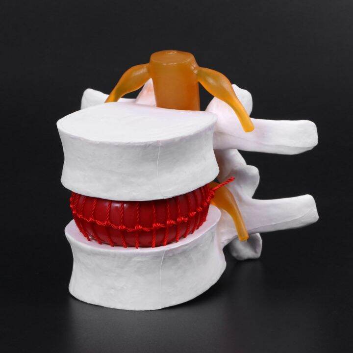 human-anatomical-lumbar-disc-herniation-model