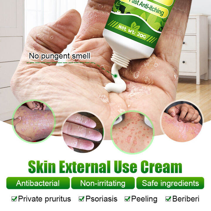 Ringworm Removal Ointment Safe Herbal Formula for the Treatment of Refractory Skin Rash and