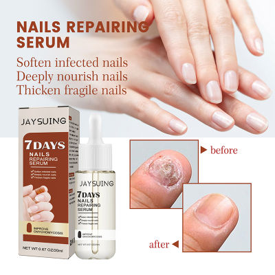 7วัน Nail Treatment Serum Foot Repair Essence Care Whitening Toe Nail Cleaning Removal Thickened Grey Nails Beauty Health