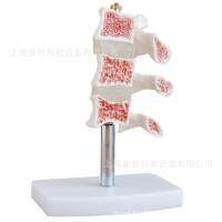 Osteoporosis model (spinal lesion typical model)