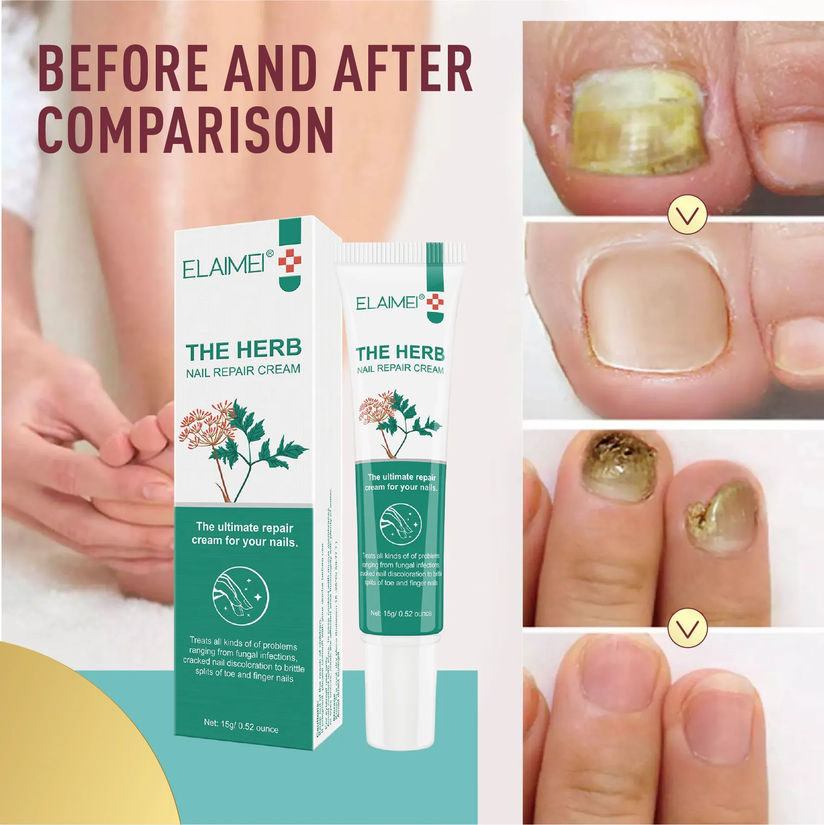 Tea Tree Oil For Nail Fungus: Effectiveness, How To Use, And Side Effects |  Herbal Essence Antibacterial Nail Treatments Essential Oil Nails Fungus  Repair 