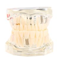 เครื่องมือทำความสะอาดฟันการสอนโรคโมเดลกรามฟันปลอมแบบถอดได้โปร่งใสสำหรับวิทยาศาสตร์