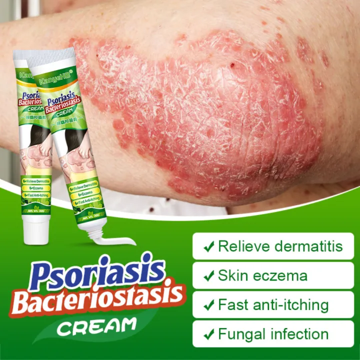 【CCmooPretty】3PCS Treatment Of Hives Psoriasis Cream Eczema Cream Antifungal Antipruritic Cream