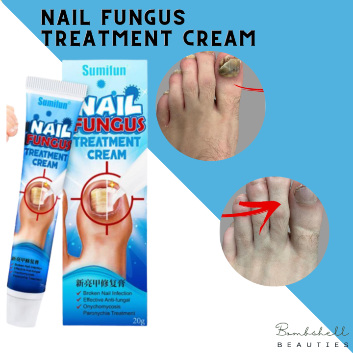 Effective Anti-Fungal | SUMIFUN Nail Fungus Treatment Cream | Nail ...