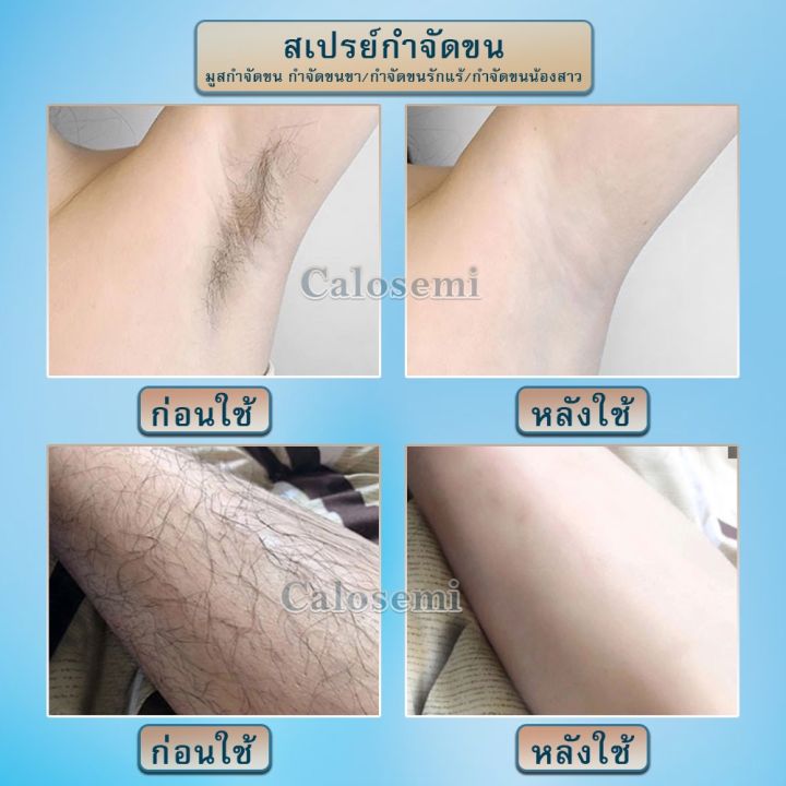 calosemi-มูสกำจัดขนถาวร-150ml-2-มูสกำจัดขน-กำจัดขนขา-กำจัดขนรักแร้-กำจัดขนน้องสาว-สเปรย์กำจัดขน