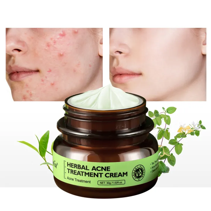 HOLD LIVE VIBRANT GLAMOUR Herbal Acne Treatment Cream With Tea Tree ...