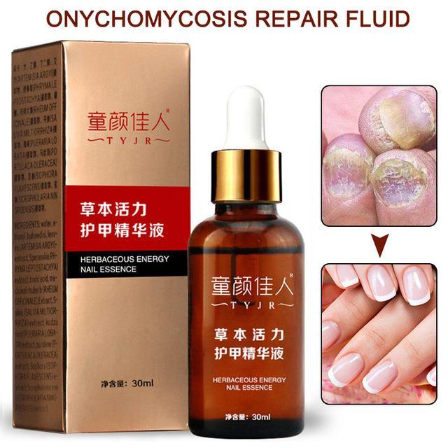 new-30ml-fungal-nail-treatment-nail-care-essence-anti-fungus-toe-nail-finger-infection-repair-liquid-sci88