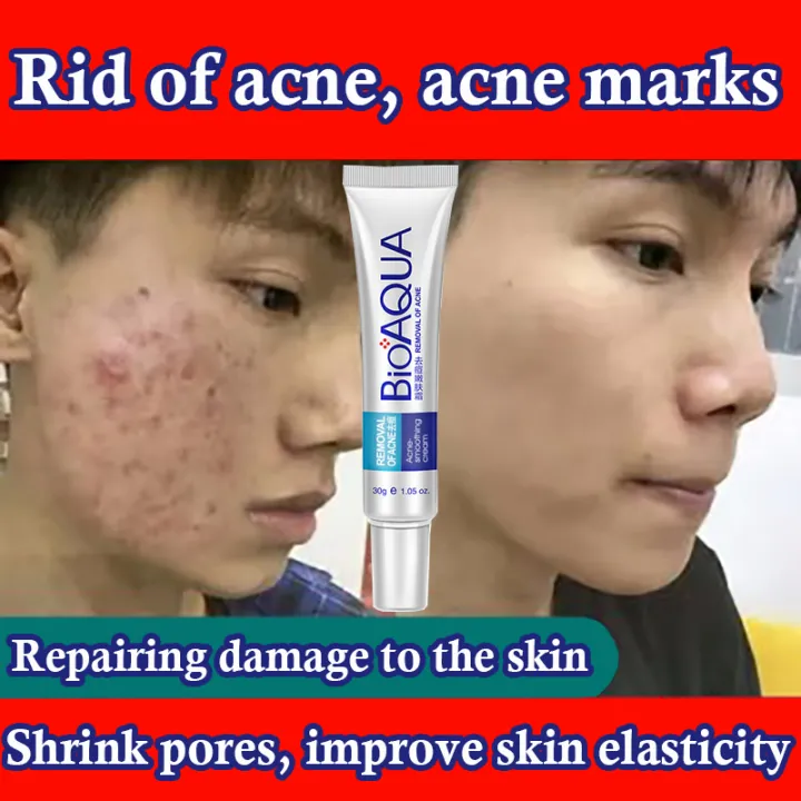 ACNE GEL Quickly Pimple Remover Acne Cream Fades Acne Marks