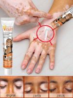 Effectively Remove Vitiligo Ointment Remove Ringworm White Spot Removal Skin Vitiligo Eliminate Vitiligo Skin Care