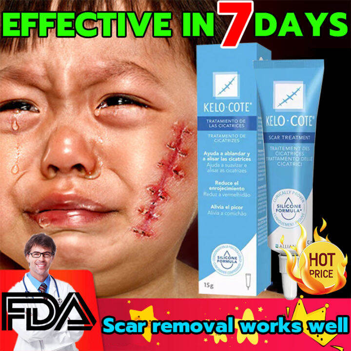 【KELOCOTE】scar remover for old scar on leg stretch mark remover acne