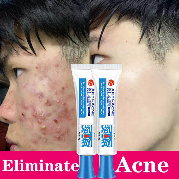 100% Effective Remove Pimples Quickly Pimple Remover Acne Cream Fades