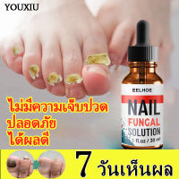 EELHOE น้ำยาบำรุงเล็บ30ml ยารักษาเล็บขบ เล็บที่มีเชื้อรา ต่อต้านแบคทีเรีย รักษาเล็บเสีย ทำให้เล็บเกิดใหม่ เล็บสวยขึ้น ยารักษาเล็บ ยาบำรุง