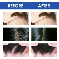 Hair Psoriasis Seborrheic Skin Care Treatments Dermatitis Eczema Head Acne Pruritus Scalp Shampoo Repair Scalp Remove Dandruff