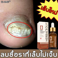 เชื้อราที่เล็บ! เซรั่มบำรุงเล็บ 30ml บอกลาทุกปัญหาเล็บ ปลอดภัย ไม่เจ็บ（เซรั่มรักษาเล็บ รักษาเชื้อราเล็บ  รักษาเล็บ บำรุงเล็บ น้ำมันบำรุงเล็บ เชื้อราเล็บมือ ยารักษาเชื้อราเล็บ รักษาเล็บเสีย รักษารคเชื้อราที่เล็บ ยารักษาเชื้อราที่เล็บ）