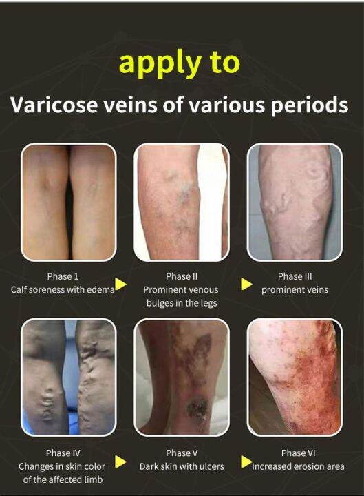 Gorich. Scar Care Varicose vein repair massage cream Leg Massage Cream