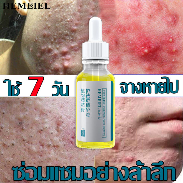 hemeiel-ลดสิว-รอยสิว-สำหรับสิวอักเสบ-เจลผักลดสิว-benzec-ละลายสิว