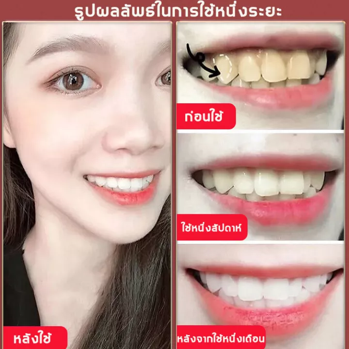 ยาสีฟันฟันขาว-เซรั่มฟอกฟันขาว-มูสแปรงฟัน-ขัดฟันขาว-ฟันเหลือง-น้ำยาฟอกฟันขาว-ยาสีฟันไวท์เทนนิ่ง-ยาสีฟันฟอ