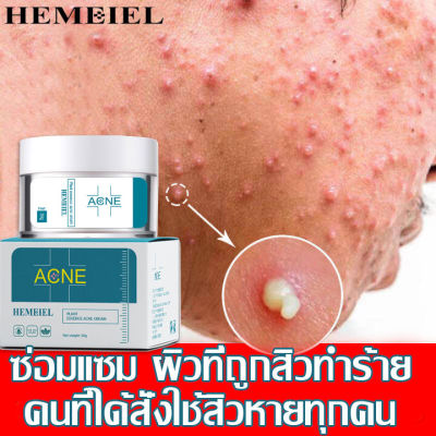 HEMEIEL ครีมกำจัดสิวเสี่ยน ทุกประเภท/สำหรับสิวอักเสบ/ลดสิว รอยสิว/ สามารถลดสิว