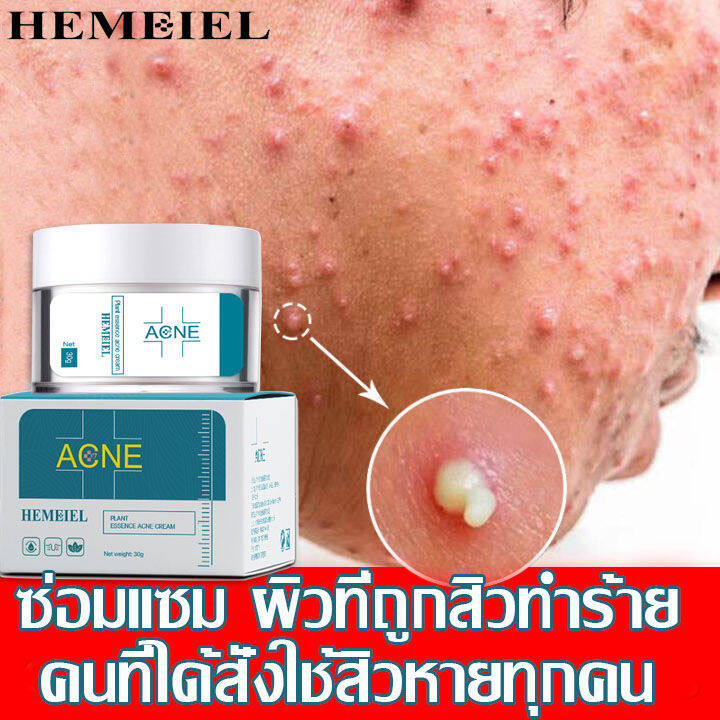 hemeiel-ครีมกำจัดสิวเสี่ยน-ทุกประเภท-สำหรับสิวอักเสบ-ลดสิว-รอยสิว-สามารถลดสิว