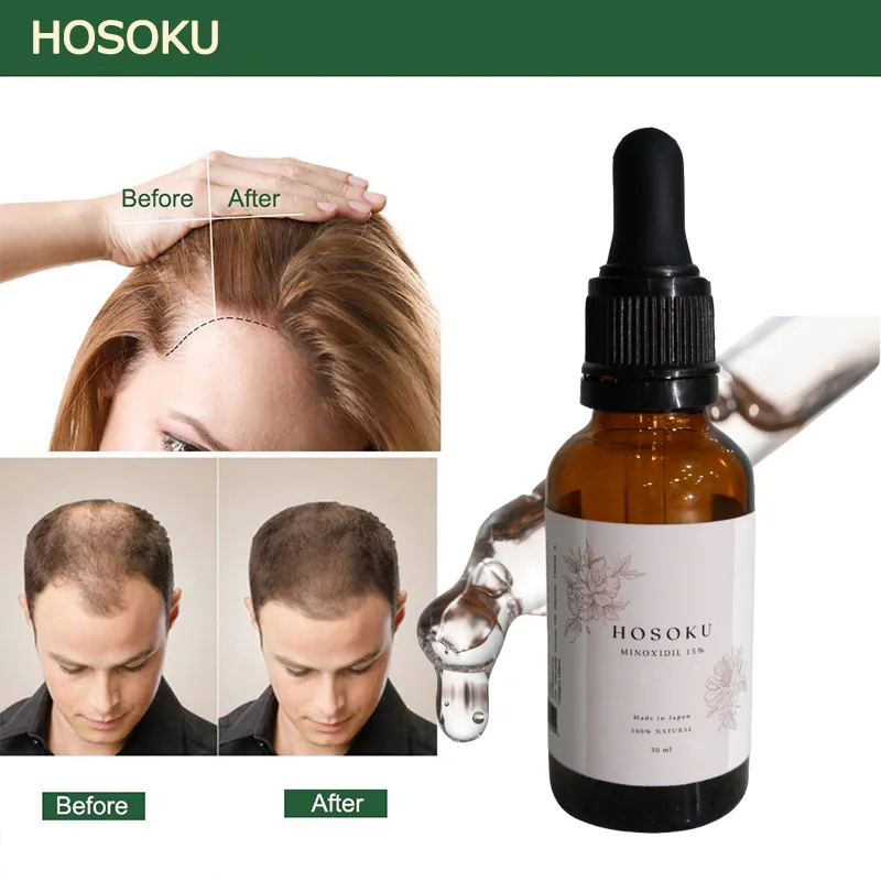 Discover 138+ minoxidil hair oil - vova.edu.vn