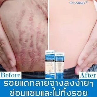 ส่งจากไทย-guanjing-ครีมกันแตกลาย-80g-ลดรอยแตกลายก่อนและหลังคลอดบุตร-ครีมลดรอยแตกลาย-ครีมทารอยแตกลาย-ยาทารอยแตกลาย