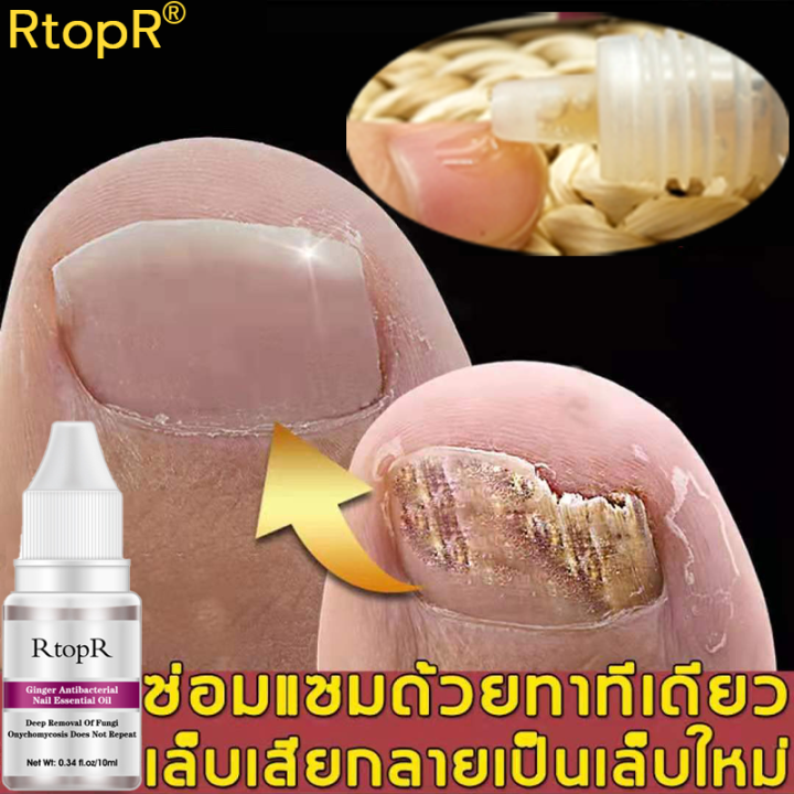 เห็นผลภายใน7วัน-rtopr-รักษาเล็บ-เล็บเท้าคุณภาพสูงกำจัดเชื้อราที่เล็บ-เอ็สเซ้นซ่อมแซมเล็บเสีย-รักษารคเชื้อราที่เล็บ-เล็บพัง-เล็บขบ-เซรั่มบำรุงเล็บ-น้ำมันบำรุงเล็บ-ดูแลเล็บ-เชื้อราเล็บมือ-น้ำยารักษาเล็บ