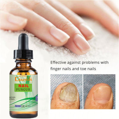 เล็บเชื้อรา Treatment Feet Care Repair Essence ป้องกันการติดเชื้อ Paronychia Onychomycosis เล็บเท้าเล็บเท้ากำจัดเชื้อราผลิตภัณฑ์