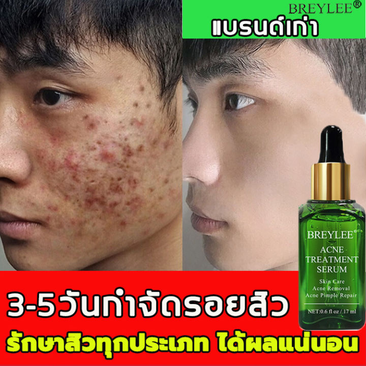 Breyleeเซรั่มลดสิว17Mlครีมลดสิวสิวอุดตันสิวผดไม่มีหัว รอยดำจากสิวรอยแดง  ครีมแต้มสิว เจลรักษาสิว เจลแต้มสิว ครีมกำจัดสิว เจวแต้มสิว ครีมสลายสิว  ครีมทาสิวต่างๆ ครีมทารอยสิว เซรั่มทารอยสิว เจลทาสิว เซรั่มหน้าใส เซรั่มบำรุง สิว เซรั่มสิวอุดตัน ครีมทาหน้าสิว ...