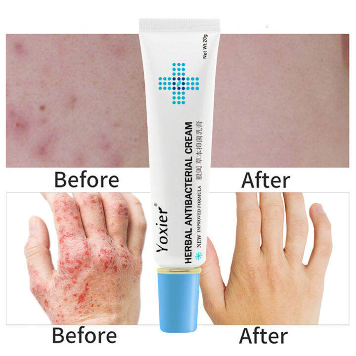 Herbal Antibacterial Cream Rash Urticaria Scaling Treatment Ointment ...