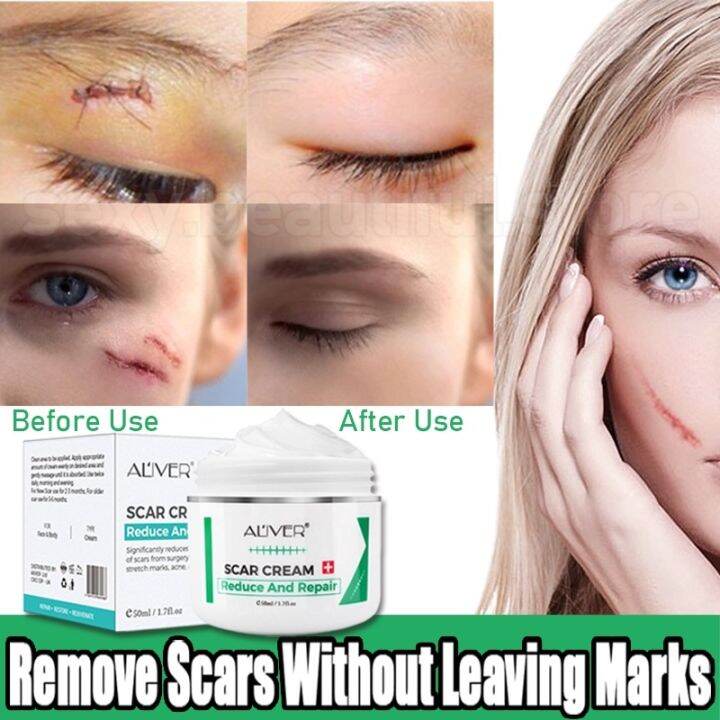 Aliver Old Scar Remover For Legs 50ml Peklat Remover Acne Surgical Stretch Marks Repair Cream 0595