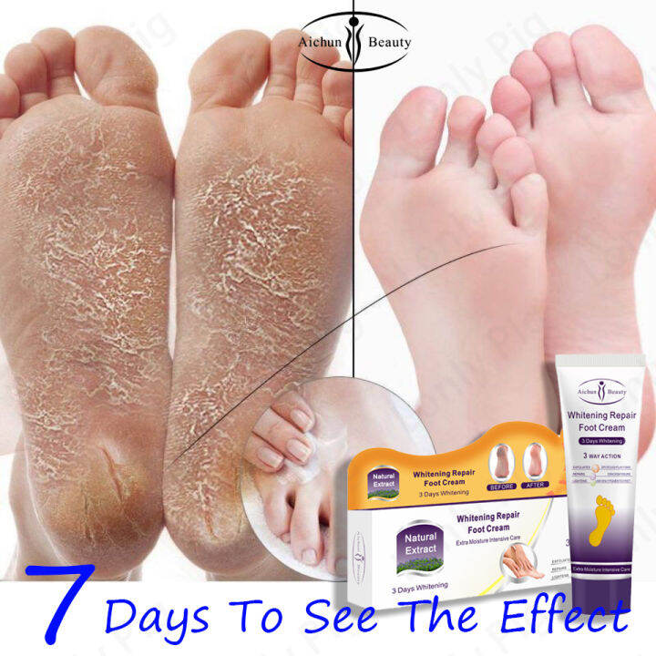 A Super Store Aichun crack heel remover cream, kalyo removal for foot