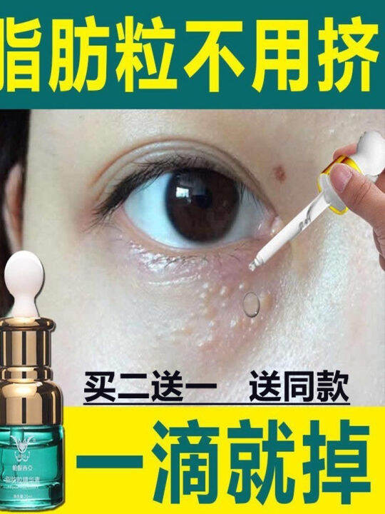 Fat granule syringoma removal artifact removes grease granules eye area