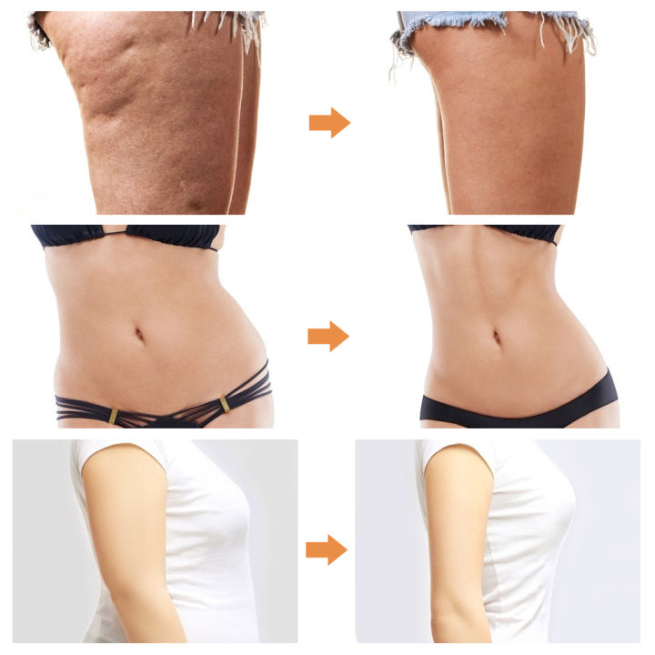 liposuction-machine-sports-fat-burner-body-shaping-slimming-machine-waist-belly-arm-leg-fitness-body-sculpting-massage-at-home