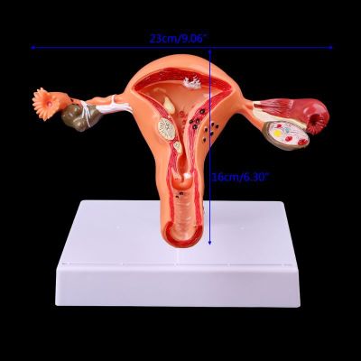 ของเล่นโมเดล pathological uterus ovary anatomical