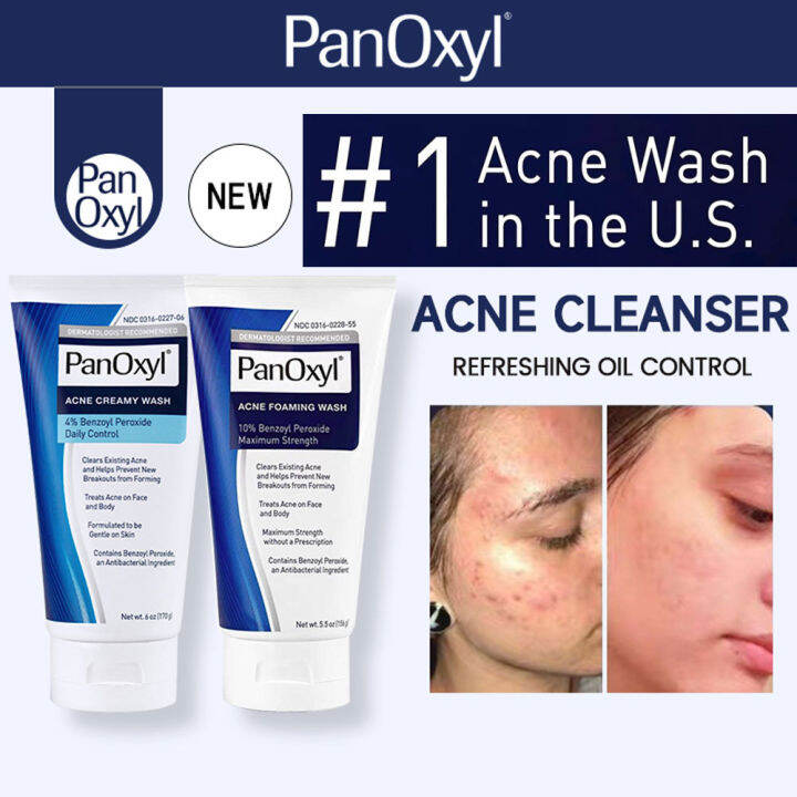 PanOxyl 4&10 Acne Treatment Cleanser Benzoyl Peroxide Acne Foaming