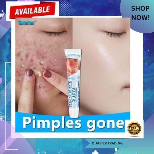 Acne remover cream acne marks pimple marks remover cream acne removal Acne Treatment cream