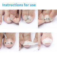 Christmas gift Warm Light 1Pcs Ingrown Toe Nail Correction Pedicure Tool Patch Fixer Recover Corrector