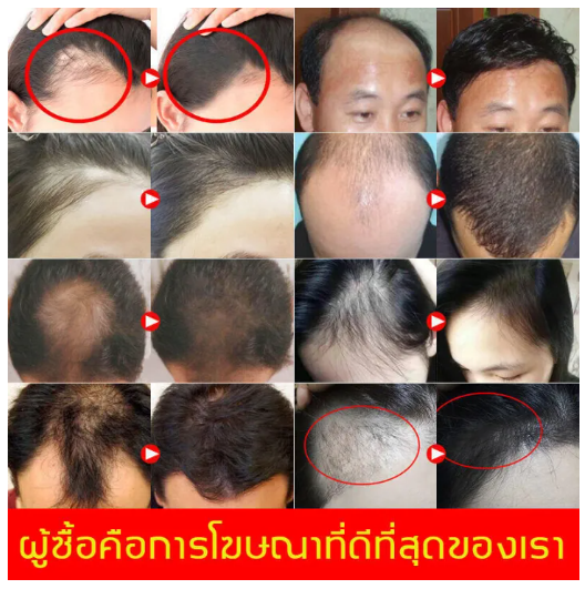 ซ่อมแซมรูขุมขน-สระออกผมหนาแน่น-peimei-แชมพูลดผมร่วง-ป้องกันผมล่วง-บำรุงรากผม-ปรับหยาบกร้าน-การดูแลหนังศีรษะ-เสริมสร้างเส้นผม-แชมพูแก้ผมร่วง-ยาสระผมเร่งยาว-แชมพูเร่งผมยาว-สระผมขิง-เซรั่มเร่งผมยาว-เซรั่