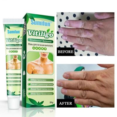 【UClanka】20g Chinese Vitiligo pigment melanin promotes the of skin whitening leukoplakia