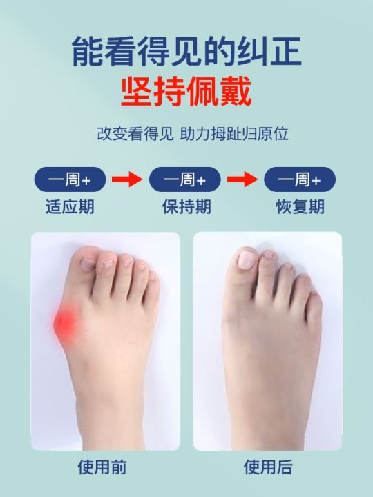 childrens-toe-corrector-thumb-valgus-toe-splitter-childrens-big-toe-bone-protrusion-correction-artifact-wearable-shoes