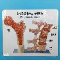 Osteoporosis type mold human femoral bone anatomical surface lumbar spine specimen cut lesions model