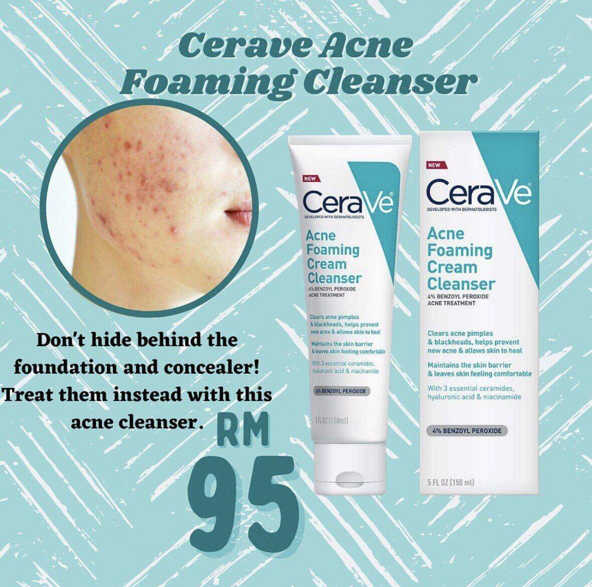 Cerave Acne Foaming Cream Cleanser 4％ Benzoyl Peroxide Acne Treatment ...