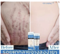 GUANJING ครีมทาท้องลาย ผิวแตกลาย80g?แก้ท้องลาย ลดรอยแตกลาย ขาแตกลาย สะโพกลาย ผิวลาย รอยแตกลาย**ของแท้ พร้อมส่ง