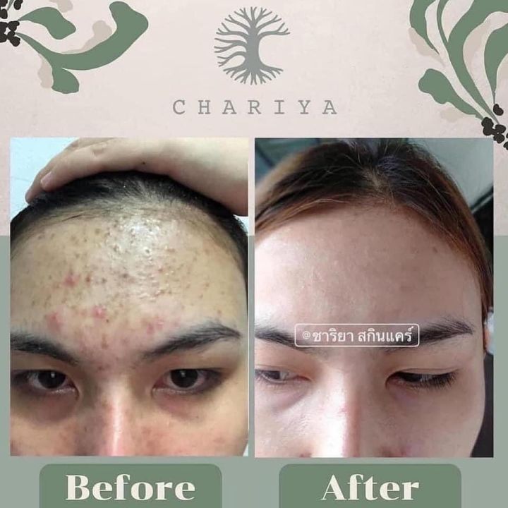 สบู่ใบบัวบก-ชาริยาchariya-ลดสิวหน้าใสของแท้100-ผิวแพ้ง่ายใช้ได้