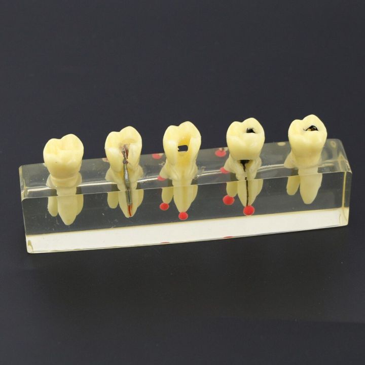 dental-endodontic-treatment-demonstration-model-4012-study-teach-teeth-model